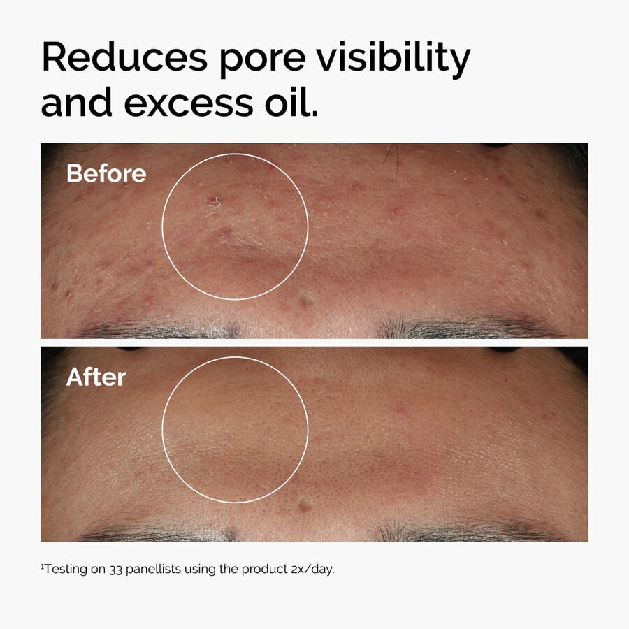 niacinamide-10-zinc-1-h6 ord-niacinamide-zinc-blemish-serum-before-after-pores.jpg