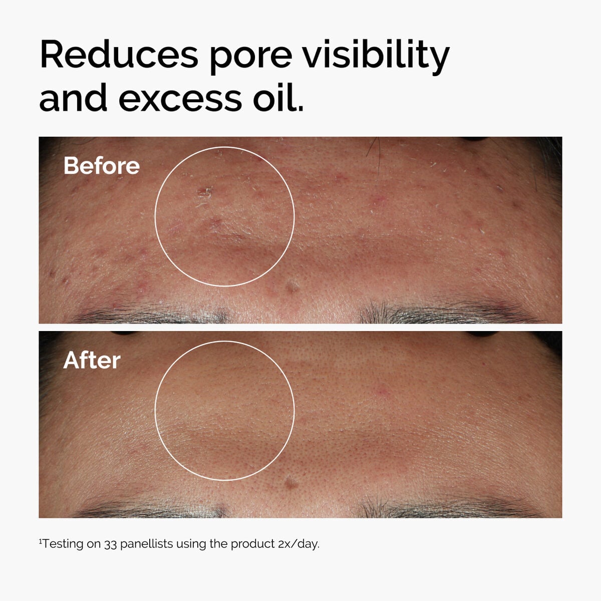 niacinamide-10-zinc-1-h6 ord-niacinamide-zinc-blemish-serum-before-after-pores.jpg