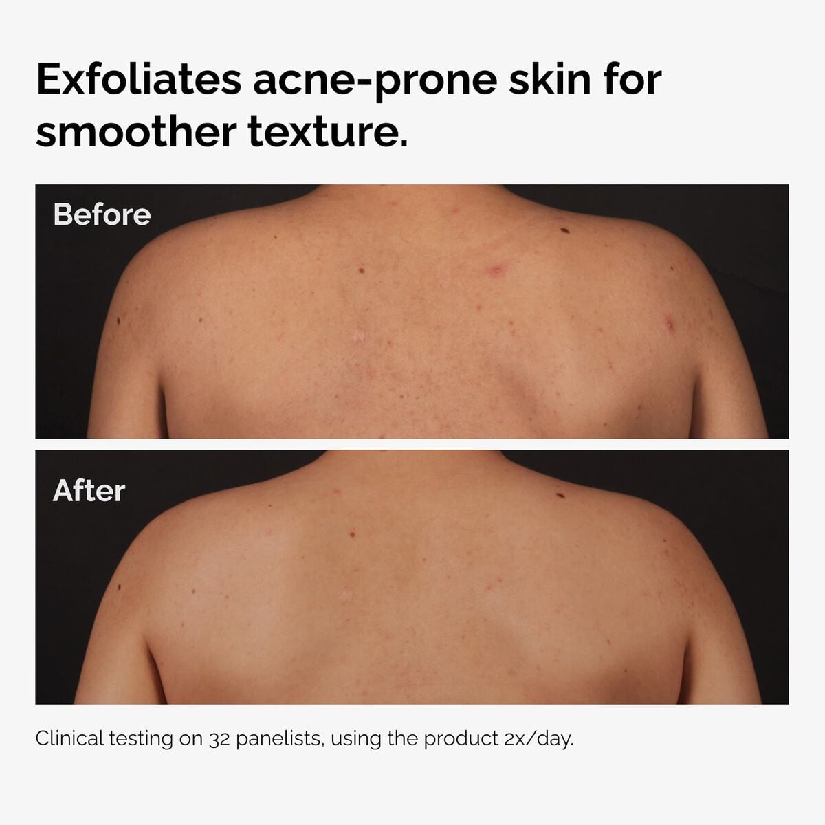 salicylic-acid-0-5-body-serum-t7 ord-salicylic-acid-body-serum-before-after-graphic-NA.jpg